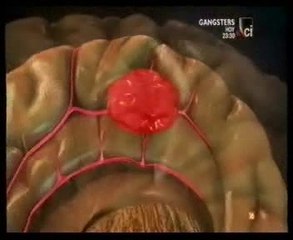 Hipertension arterial (Ictus hemorragico): Autopsia forense