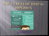 Top 5 Facts Of Dental Implants