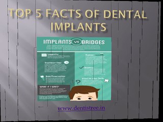 Top 5 Facts Of Dental Implants