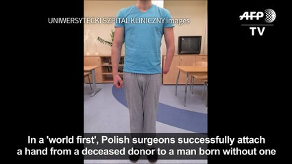 Polish surgeons succesfully attach hand to man born without one-P2uP5i2OR5M