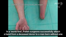 Polish surgeons succesfully attach hand to man born without one