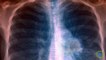 Lung Cancer Can Strike Youngest and Healthiest Non-Smokers