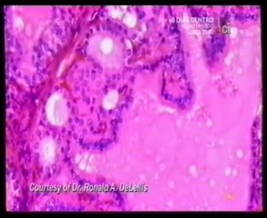 Enfermedad de Graves (Hipertiroidismo): Autopsia forense