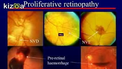 Diabetes and Eye Disease