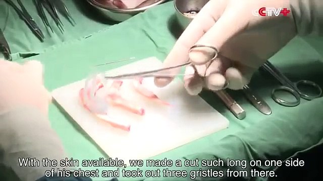 Chinese doctor grows ear on man's ARM to restore his hearing