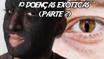 10 Doenças exóticas que você não conhecia
