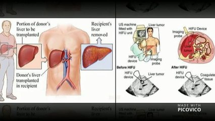 Liver Cancer Treatment