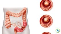 Colon Cancer Location Affects Patient Survival Rate, study finds