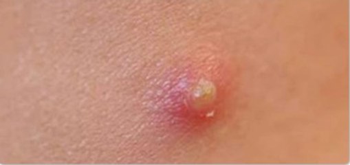 How Acne or Pimple Forms Under Skin