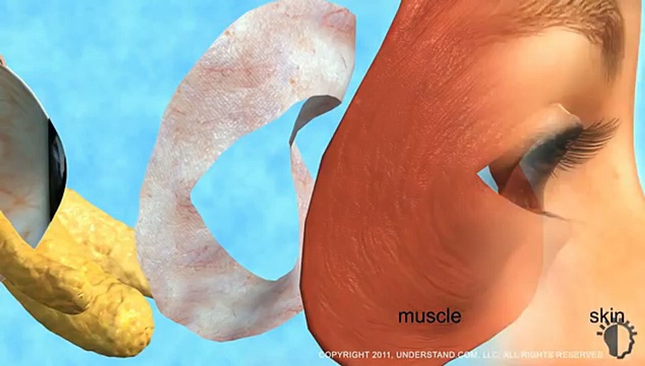 Eyelid Surgery (Blepharoplasty)Op.Dr.M.METE