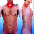 Cervical Disc Herniation Surgery by Dr. Charla Fischer