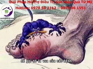 Bệnh GÚT có chữa khỏi được không?