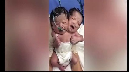 Un bébé à deux têtes né au Mexique