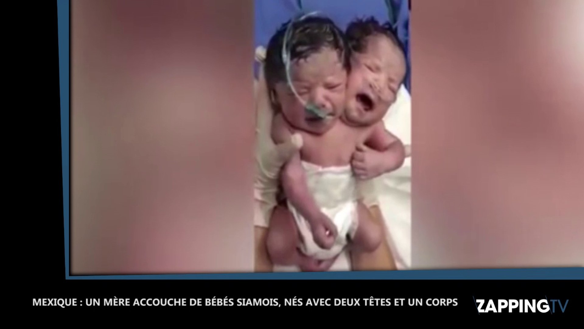 Une Mere Accouche D Un Bebe A Deux Tetes Video Video Dailymotion
