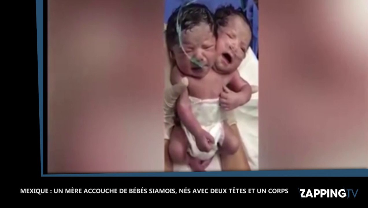 Une mère accouche d'un bébé à deux têtes