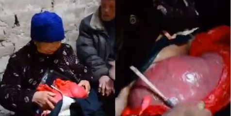 Este Mulher Vive Com Os Intestinos Fora Do Corpo Em Sacos De Compras À Mais De 20 Anos!