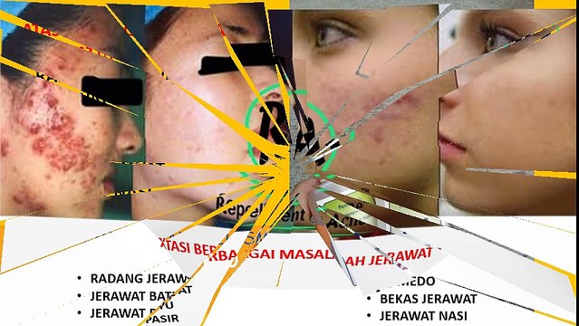 HP 085 728 237 840 Obat Jerawat Batu Yang Paling Ampuh Manjur Cepat Di Apotik