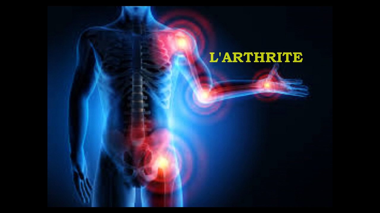 L'ARTHRITE