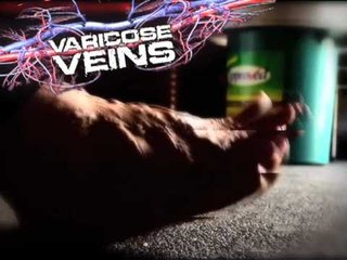 Pinoy MD: Freckles and Varicose Veins!