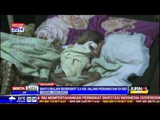Bayi Gizi Buruk Beratnya 2,4 Kilogram