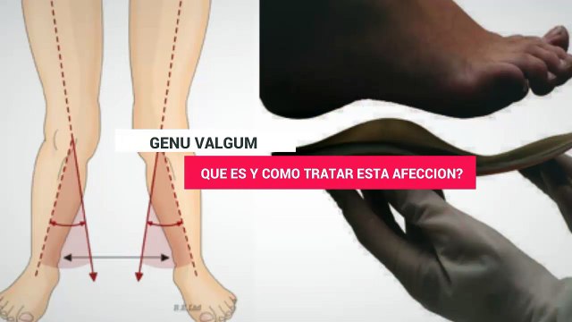 Que Es El Genu Valgum O Pata de Catre? y Como Podemos Tratar Este Padecimiento