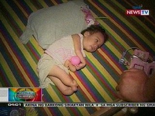 BP: 4-anyos na babae, 'di makalakad dahil sa magkadikit niyang paa