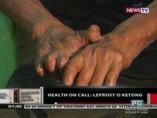 OC: Health On Call: Leprosy o Ketong