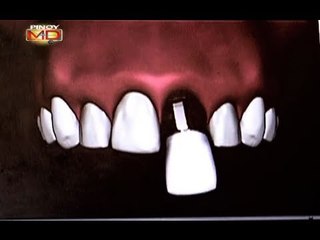 Bungi ka ba? Magpa-dental implants na!