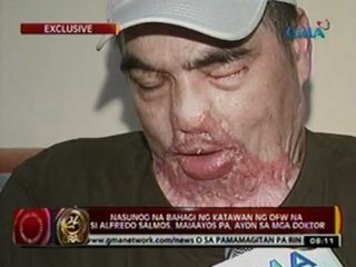 24 Oras: Nasunog na bahagi ng katawan ng OFW na si Alfredo Salmos, maiaayos pa