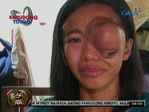 24 Oras: Inang may malaking bukol sa mata, nagpapakatatag para sa kanyang pamilya