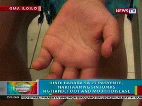 BP: Hindi bababa sa 27 pasyente sa Iloilo, nakitaan ng sintomas ng Hand, Foot and Mouth disease