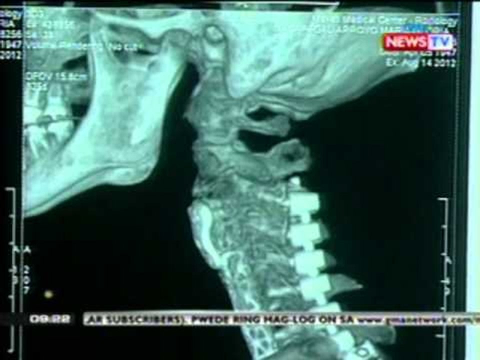 Rep. Arroyo, nakalabas na ng ospital pero kritikal pa rin ang kondisyon, ayon sa kanyang doktor