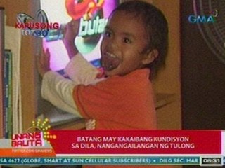 UB: Batang may kakaibang kundisyon sa dila, nangangailangan ng tulong