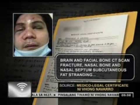 24 Oras: Mga sugat ni Vhong Navarro, posibleng abutin nang isang buwan bago gumaling