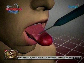 24 Oras: Batang lumalaki ang dila, sumailalim sa matagumpay na operasyon
