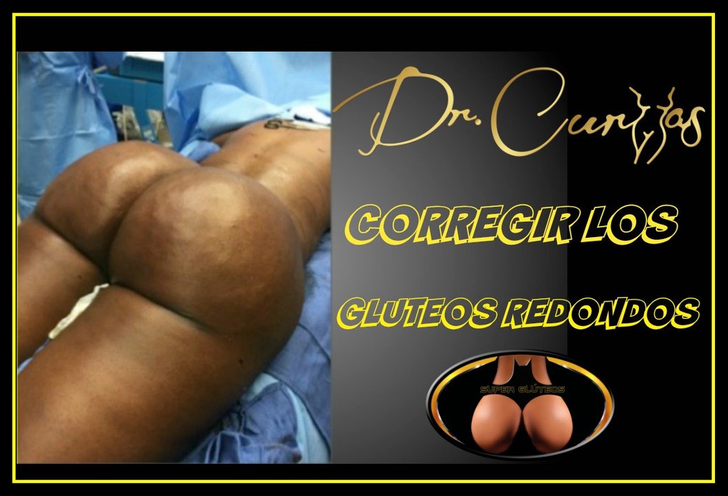 Corregir glúteos redondos
