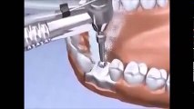Dental Implants Dentist  Forest Hills