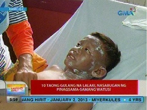 UB: 10 taong gulang na lalaki, nasabugan ng pinagsama-samang watusi