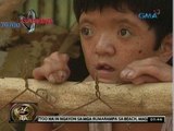 24 Oras:  Dalagitang magkakadikit ang mga daliri sa kamay at paa, ipinasuri sa doktor