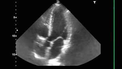 Fibrillation Auriculaire (FA) en échographie - Atrial Fibrillation (AF) ultrasound