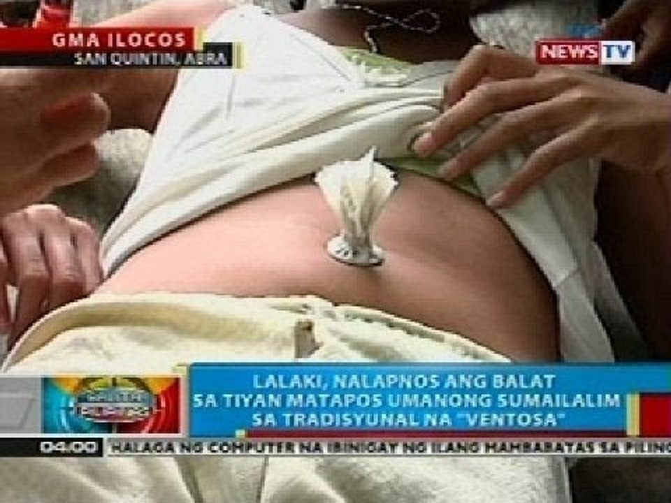 Lalaki sa Abra, nalapnos ang balat sa tiyan matapos umanong sumailalim sa tradisyunal na 'ventosa'