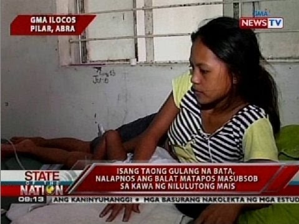 Isang taong gulang na bata, nalapnos ang balat matapos masubsob sa kawa ng nilulutong mais