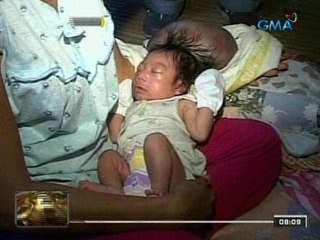 24 Oras: Sanggol, ipinanganak na may malaking bukol sa ulo