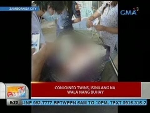 UB: Conjoined twins, isinilang na wala nang buhay