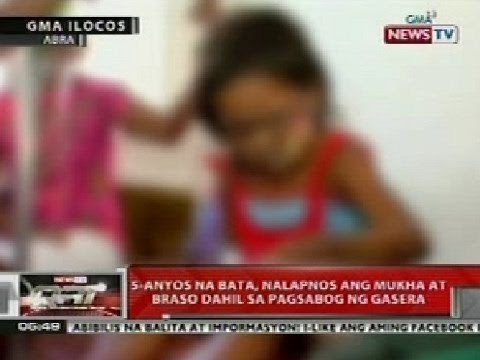 QRT: 5-anyos na bata sa Abra, nalapnos ang mukha at braso dahil sa pagsabog ng gasera