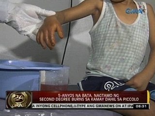 24 Oras: Bata, nagtamo ng second degree burns sa kamay dahil sa piccolo