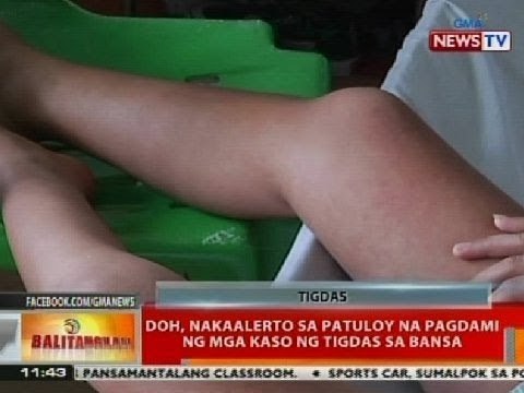 BT: DOH, nakaalerto sa patuloy na pagdami ng mga kaso ng tigdas sa bansa
