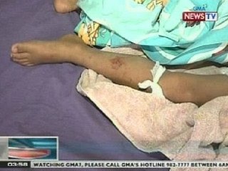 BP: Estudyante, nasugatan matapos mabangga ng motorsiklo sa Danglas, Abra