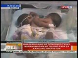 BT: Mga magulang ng conjoined twins, nananawagan ng tulong para sa kanilang operasyon