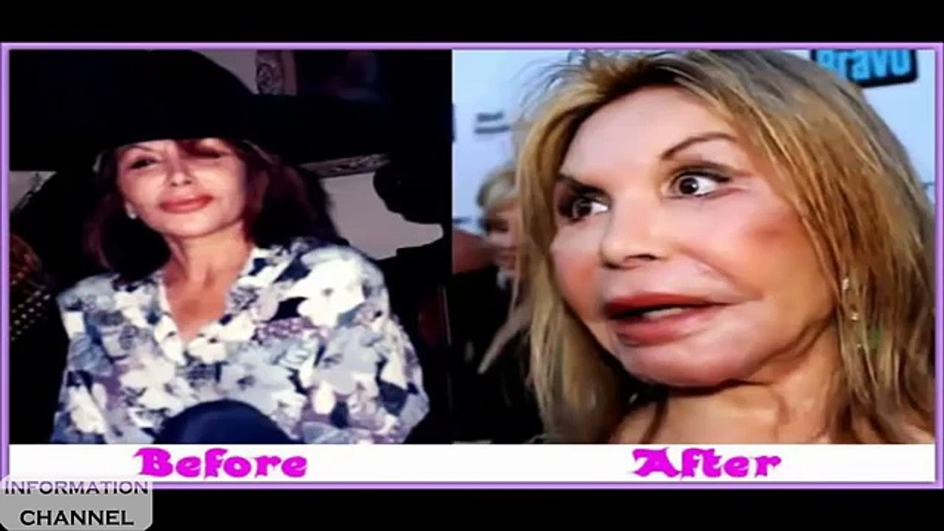 ⁣200 Picture of plastic surgery fail before after    Worst Plastic Surgery Ever    Oops 2015